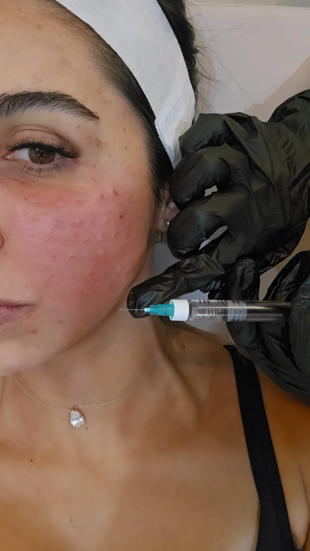 A practitioner injects a skin booster into a client's flushed cheek